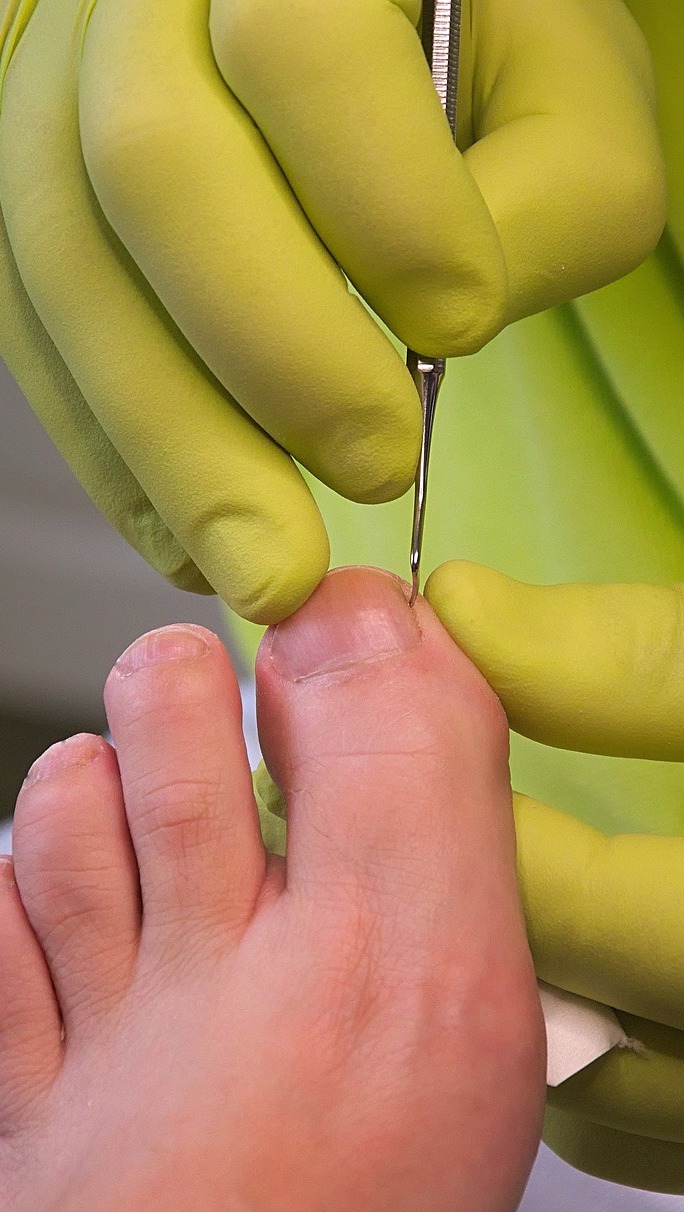 imagen especialidad ACUPUNTURA